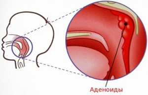 Аденоиды казнить нельзя помиловать - Леднева слив курса