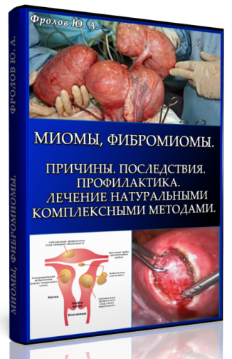 Мини инфопродукт №7. Миомы, Фибромиомы. Причины. Последствия. Профилактика. слив курса